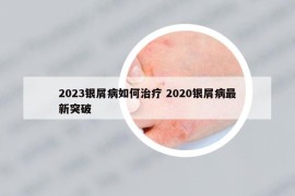 2023银屑病如何治疗 2020银屑病最新突破