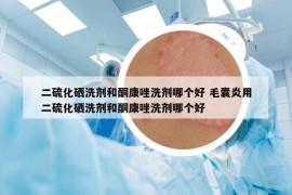 二硫化硒洗剂和酮康唑洗剂哪个好 毛囊炎用二硫化硒洗剂和酮康唑洗剂哪个好