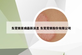 东莞银屑病最新消息 东莞莞银股份有限公司