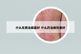 什么东西治癣最好 什么药治癣效果好