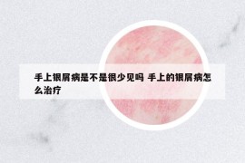 手上银屑病是不是很少见吗 手上的银屑病怎么治疗