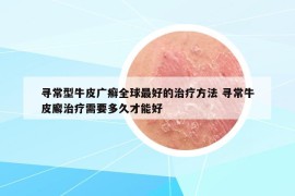 寻常型牛皮广癣全球最好的治疗方法 寻常牛皮廨治疗需要多久才能好