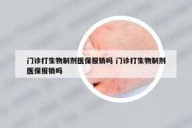 门诊打生物制剂医保报销吗 门诊打生物制剂医保报销吗