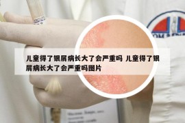 儿童得了银屑病长大了会严重吗 儿童得了银屑病长大了会严重吗图片