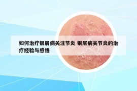 如何治疗银屑病关注节炎 银屑病关节炎的治疗经验与感悟