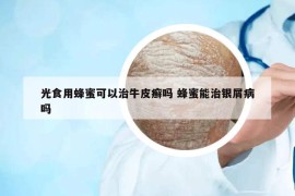 光食用蜂蜜可以治牛皮癣吗 蜂蜜能治银屑病吗