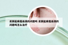 皮肤起癣是血液的问题吗 皮肤起癣是血液的问题吗怎么治疗