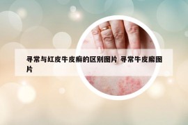寻常与红皮牛皮癣的区别图片 寻常牛皮廨图片