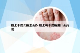 脸上干皮长癣怎么办 脸上有干皮癣用什么药膏