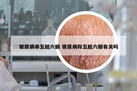 银屑病串五脏六腑 银屑病和五脏六腑有关吗