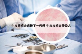牛皮肤癣会遗传下一代吗 牛皮皮癣会传染人吗