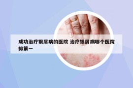 成功治疗银屑病的医院 治疗银屑病哪个医院排第一