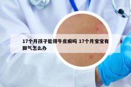 17个月孩子能得牛皮癣吗 17个月宝宝有脚气怎么办