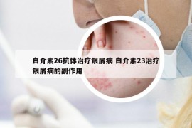 白介素26抗体治疗银屑病 白介素23治疗银屑病的副作用
