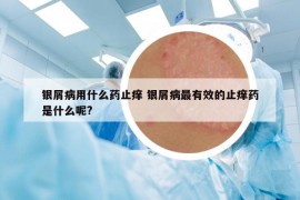 银屑病用什么药止痒 银屑病最有效的止痒药是什么呢?