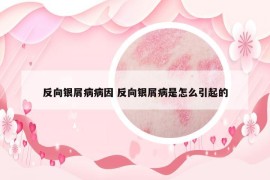 反向银屑病病因 反向银屑病是怎么引起的