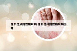什么是顽固性银屑病 什么是顽固性银屑病图片