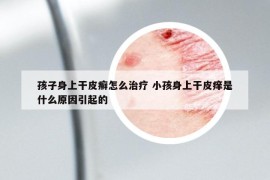 孩子身上干皮癣怎么治疗 小孩身上干皮痒是什么原因引起的