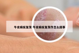 牛皮癣反复发 牛皮癣反复发作怎么回事