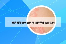 鲜清是管银屑病的吗 清鲜草是治什么的