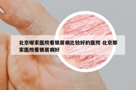 北京哪家医院看银屑病比较好的医院 北京那家医院看银屑病好