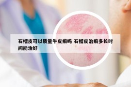 石榴皮可以质量牛皮癣吗 石榴皮治癣多长时间能治好