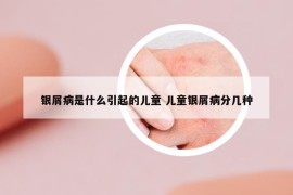 银屑病是什么引起的儿童 儿童银屑病分几种