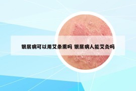 银屑病可以用艾条熏吗 银屑病人能艾灸吗