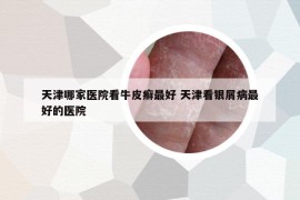 天津哪家医院看牛皮癣最好 天津看银屑病最好的医院