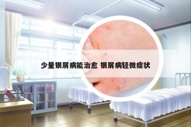 少量银屑病能治愈 银屑病轻微症状