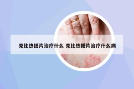 克比热提片治疗什么 克比热提片治疗什么病