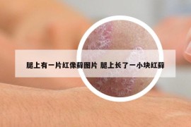 腿上有一片红像藓图片 腿上长了一小块红藓