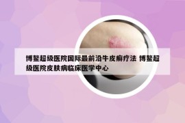 博鳌超级医院国际最前沿牛皮癣疗法 博鳌超级医院皮肤病临床医学中心