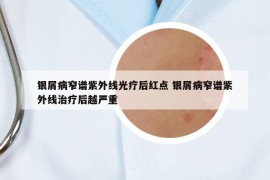 银屑病窄谱紫外线光疗后红点 银屑病窄谱紫外线治疗后越严重