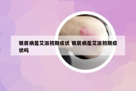 银屑病是艾滋初期症状 银屑病是艾滋初期症状吗