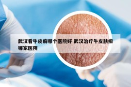 武汉看牛皮癣哪个医院好 武汉治疗牛皮肤癣哪家医院