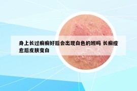 身上长过癣癣好后会出现白色的班吗 长癣痊愈后皮肤变白
