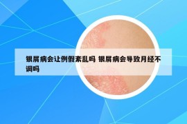 银屑病会让例假紊乱吗 银屑病会导致月经不调吗