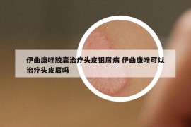 伊曲康唑胶囊治疗头皮银屑病 伊曲康唑可以治疗头皮屑吗