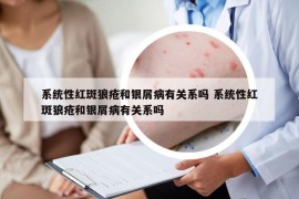 系统性红斑狼疮和银屑病有关系吗 系统性红斑狼疮和银屑病有关系吗