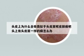 头皮上为什么会有类似于头皮屑呢皮肤癣吧 头上有头皮屑一样的癣怎么办