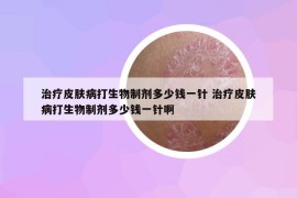 治疗皮肤病打生物制剂多少钱一针 治疗皮肤病打生物制剂多少钱一针啊