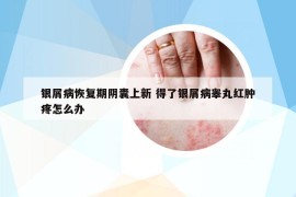 银屑病恢复期阴囊上新 得了银屑病睾丸红肿疼怎么办