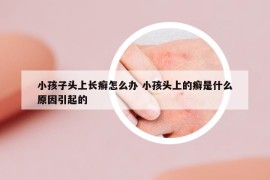 小孩子头上长癣怎么办 小孩头上的癣是什么原因引起的