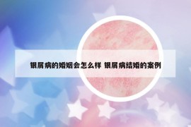 银屑病的婚姻会怎么样 银屑病结婚的案例