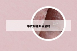 牛皮癣能喝点酒吗