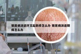 银屑病消退环又起新疹怎么办 银屑病消退期痒怎么办