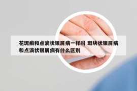 花斑癣和点滴状银屑病一样吗 斑块状银屑病和点滴状银屑病有什么区别