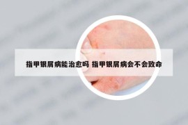 指甲银屑病能治愈吗 指甲银屑病会不会致命