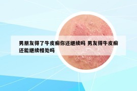 男朋友得了牛皮癣你还继续吗 男友得牛皮癣还能继续相处吗